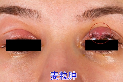 麦粒肿图片