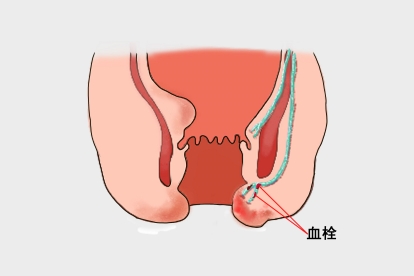 肛门急性血栓痔疮图片
