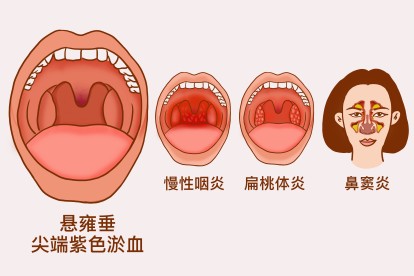 慢性咽炎、扁桃体炎、鼻窦炎