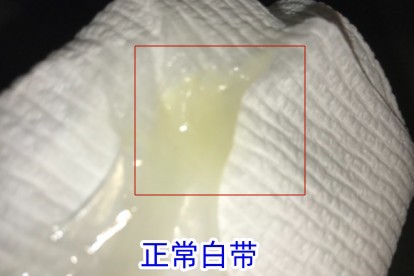 正常白带图