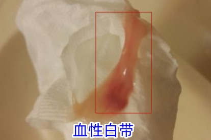 血性白带图