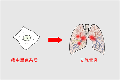 支气管炎图