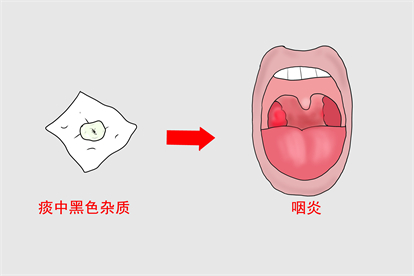 咽炎图片