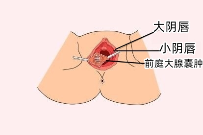 前庭大腺囊肿图