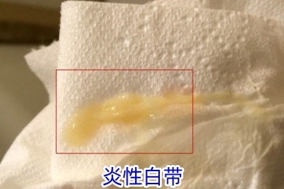 炎性白带图