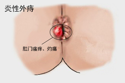炎性外痔图