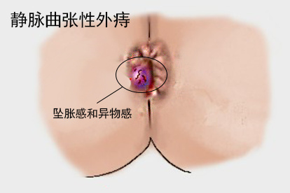 静脉曲张性外痔图
