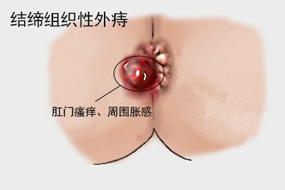 结缔组织性外痔图