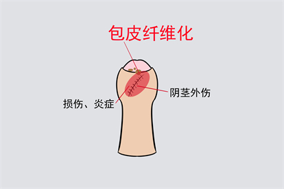 阴茎外伤图