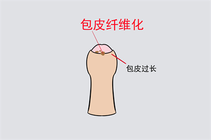 包皮过长图