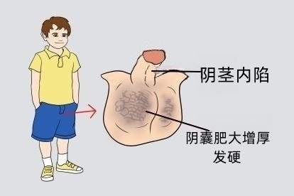 阴茎阴囊橡皮肿图