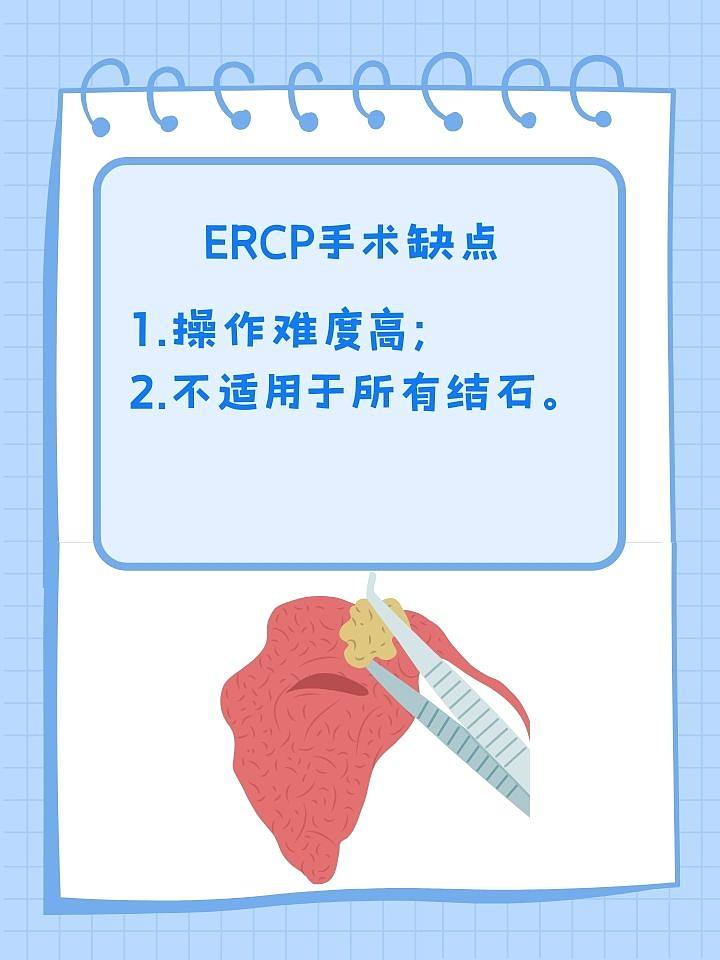 ERCP胆管结石手术：“取石”之旅