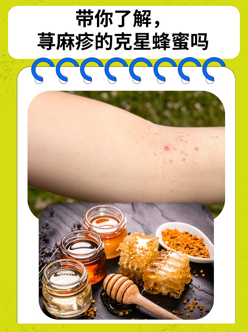 带你了解，荨麻疹的克星是蜂蜜吗