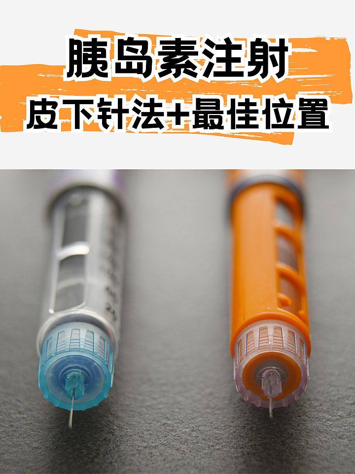 胰岛素注射小秘诀：皮下针法+最佳位置！