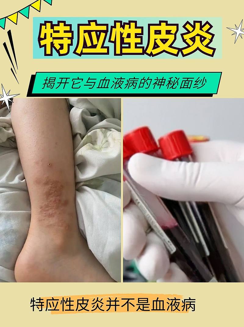 特应性皮炎：揭开它与血液病的神秘面纱